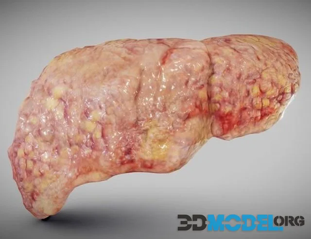 Fatty Liver