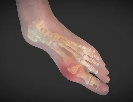 Gout (PBR)