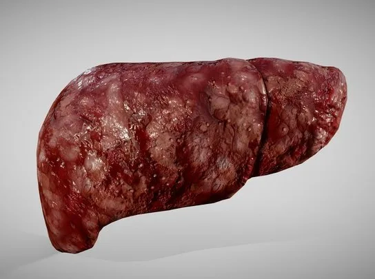 Hepatocellular Carcinoma HCC Liver Cancer