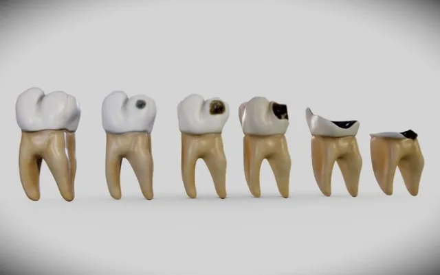 Tooth Decay Progression (Dental Caries) (PBR)