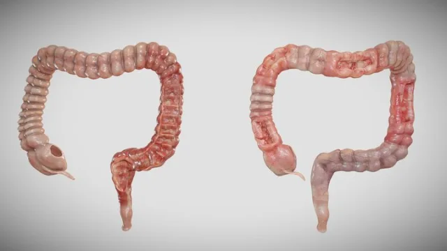 Ulcerative Colitis VS Crohn's Disease (PBR)