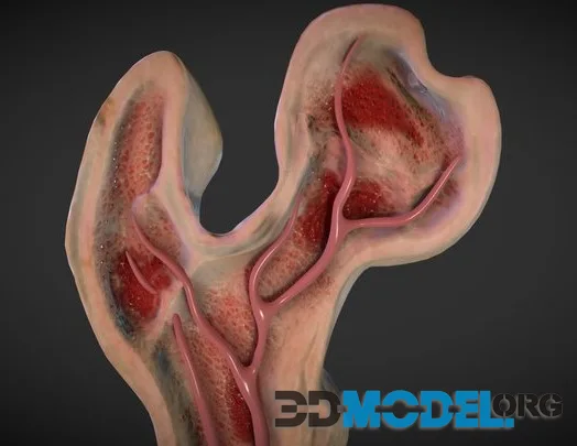 Osteolytic Lesion (PBR)